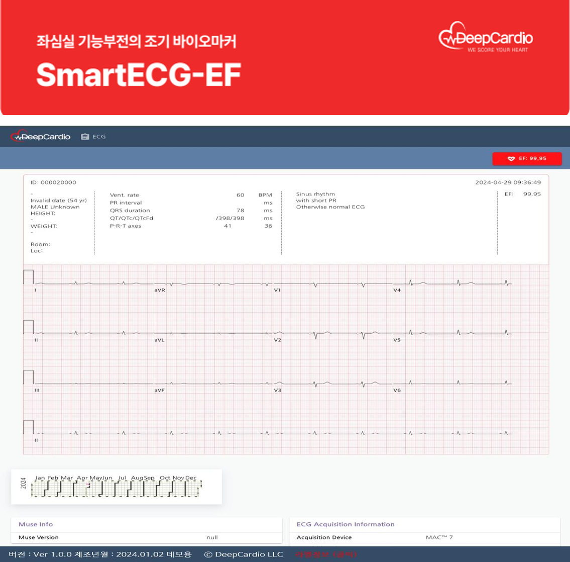 SmartECG-EF